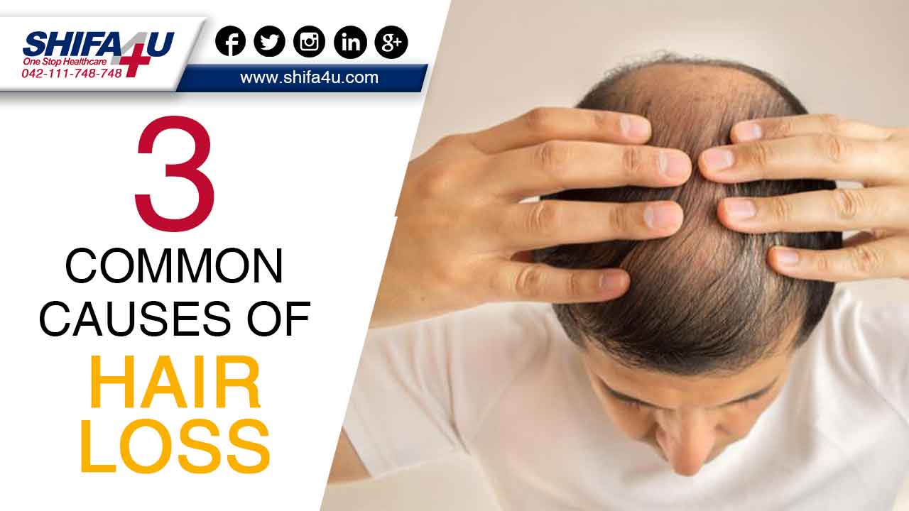 3 Most Common Causes of Hair Loss and Baldness