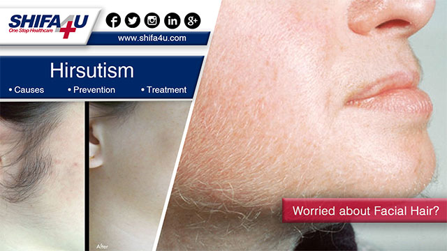 Hirsutism: Symptoms & Treatment | 7 Causes of Excess Facial Hair in Women