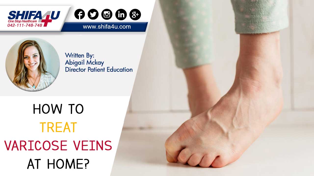 exercises for varicose veins treatment)