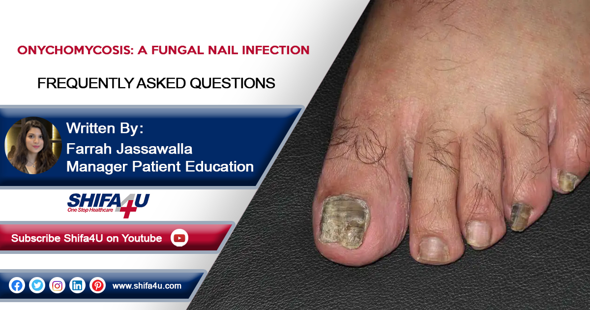 Onychomycosis: A Fungal Nail Infection