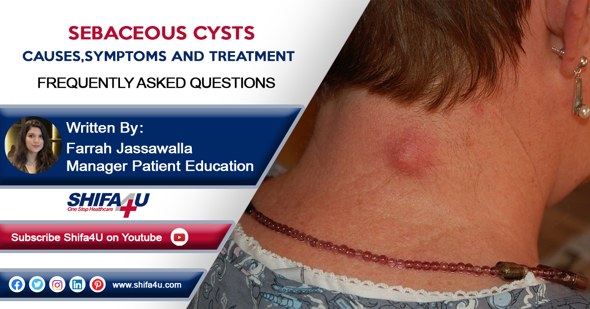 Sebaceous Cysts Causes Symptoms And Treatment