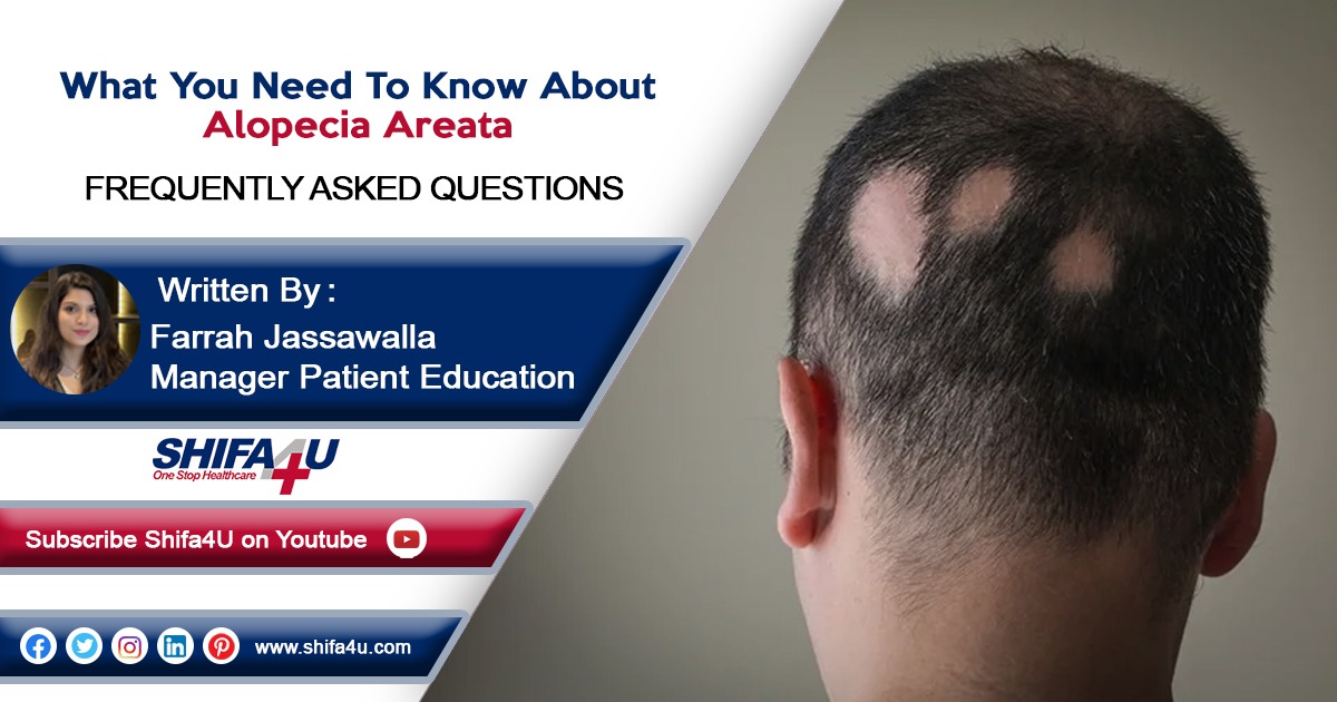 What You Need To Know About Alopecia Areata